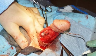 operacja powiększenia penisa