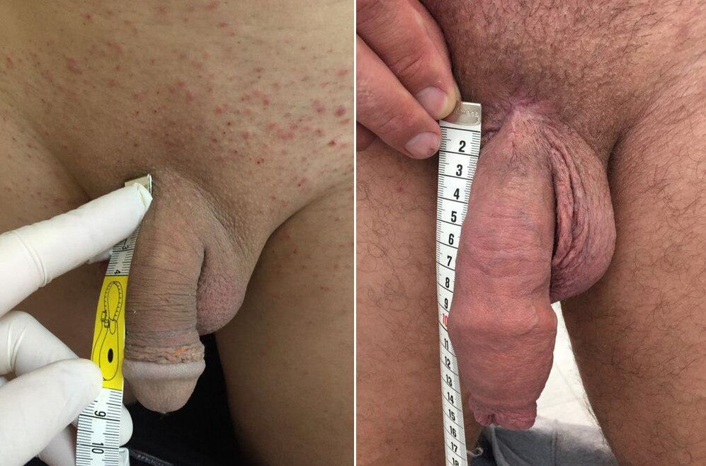 przed i po operacji powiększania penisa